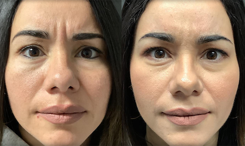 Wrinkle Reduction Before After Mississauga Neurotoxin info